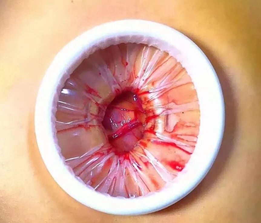 为什么不用切口保护套龚瑶专栏 ｜ 切口保护套在腹腔镜术中的 5 大妙用_https://www.jmylbn.com_新闻资讯_第2张