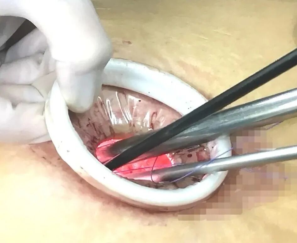 为什么不用切口保护套龚瑶专栏 ｜ 切口保护套在腹腔镜术中的 5 大妙用_https://www.jmylbn.com_新闻资讯_第4张