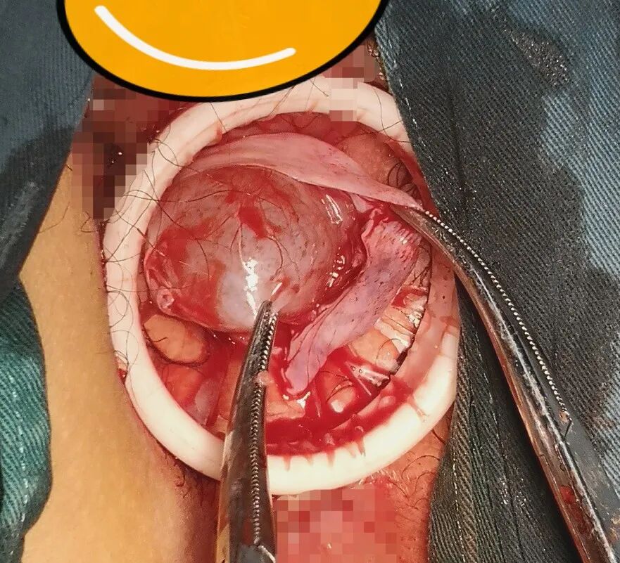 为什么不用切口保护套龚瑶专栏 ｜ 切口保护套在腹腔镜术中的 5 大妙用_https://www.jmylbn.com_新闻资讯_第7张