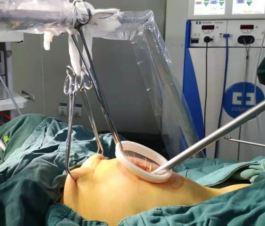 为什么不用切口保护套龚瑶专栏 ｜ 切口保护套在腹腔镜术中的 5 大妙用_https://www.jmylbn.com_新闻资讯_第3张