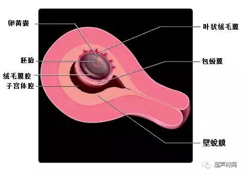早孕期絨毛膜下血腫有何臨床意義 如何治療 婦產時間 微文庫