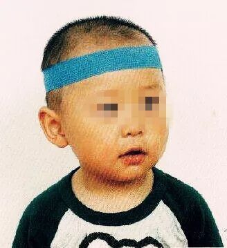 留置针绷带怎么缠小儿静脉留置针的7个固定小妙招，儿科护士都学起来！_https://www.jmylbn.com_新闻资讯_第10张