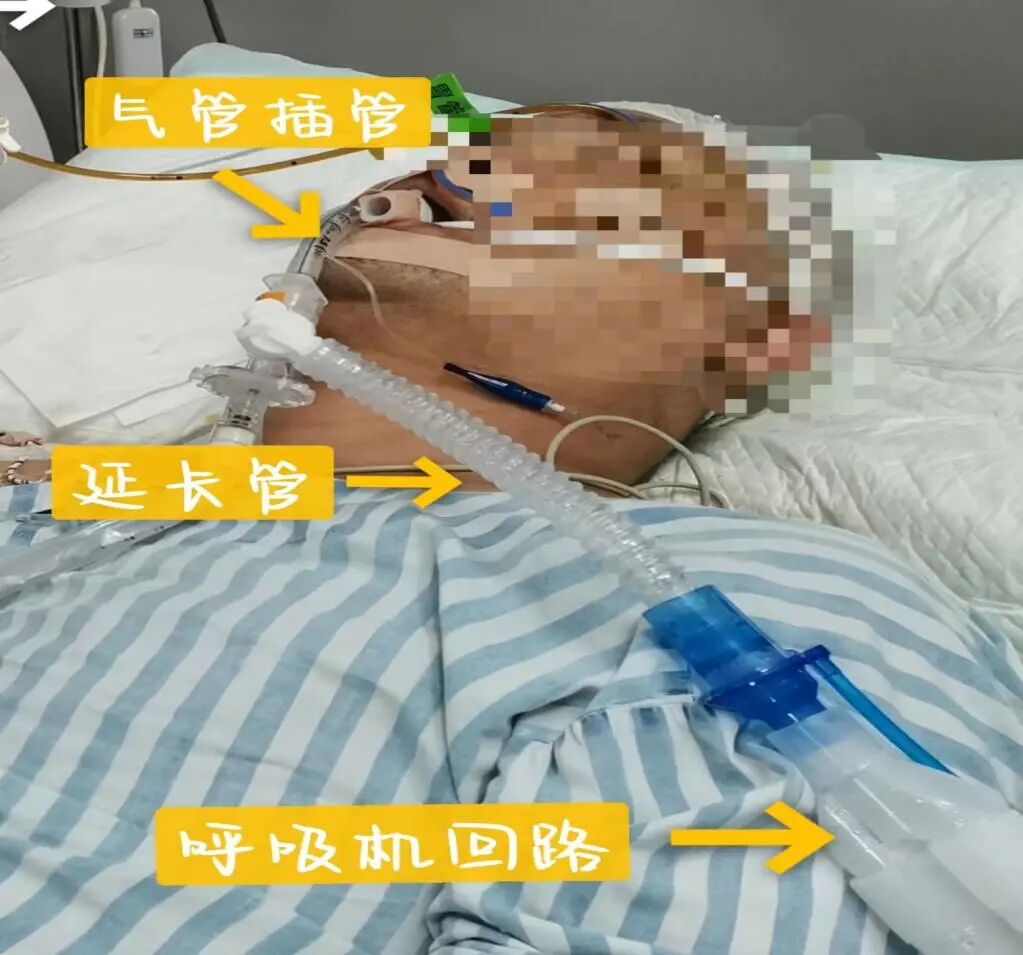 气管插管的管是什么知多D ｜ 气管插管是什么？你想知道的全在这里_https://www.jmylbn.com_新闻资讯_第7张