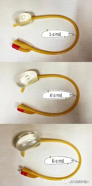 弯头导尿管怎么用小小尿管作用大，自行拔出危害大！_https://www.jmylbn.com_新闻资讯_第18张