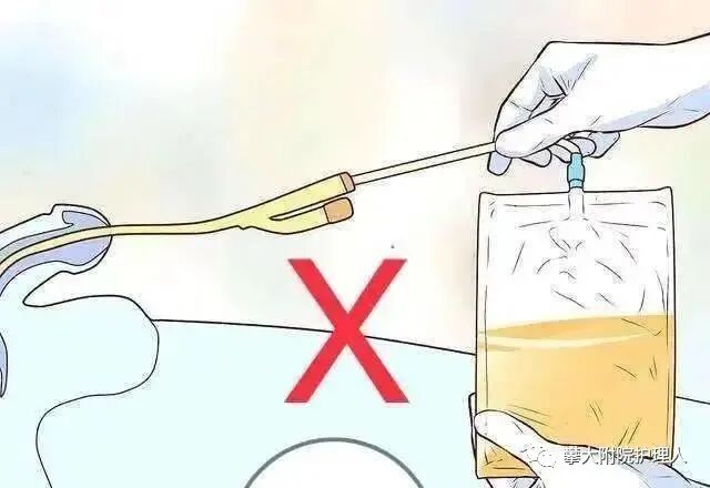弯头导尿管怎么用小小尿管作用大，自行拔出危害大！_https://www.jmylbn.com_新闻资讯_第23张