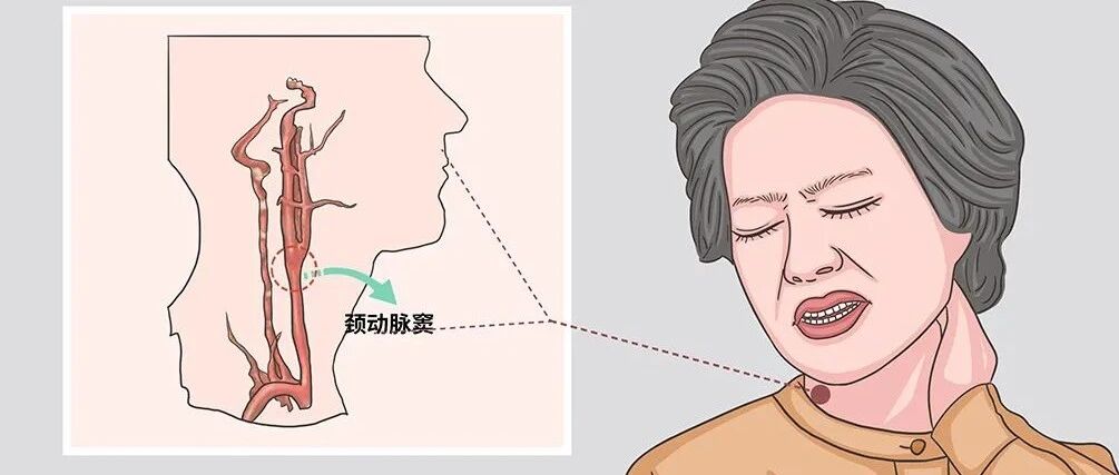有种心律失常叫「衣领综合征」，穿高领、系围巾都要小心了