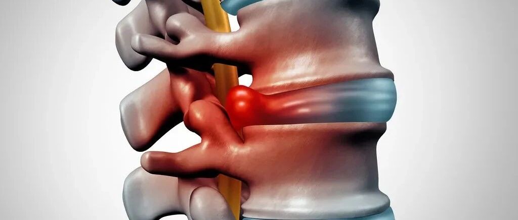 80%的腰椎间盘突出症，靠这4种方法能缓解