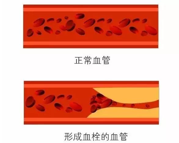 血管從通暢到堵死只要3步！做對6件事不給血管「添堵」 健康 第13張