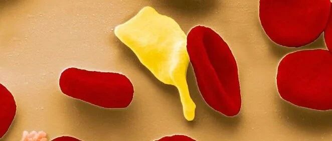 350万人体检，血脂异常最多！专家推荐首选“降脂法”