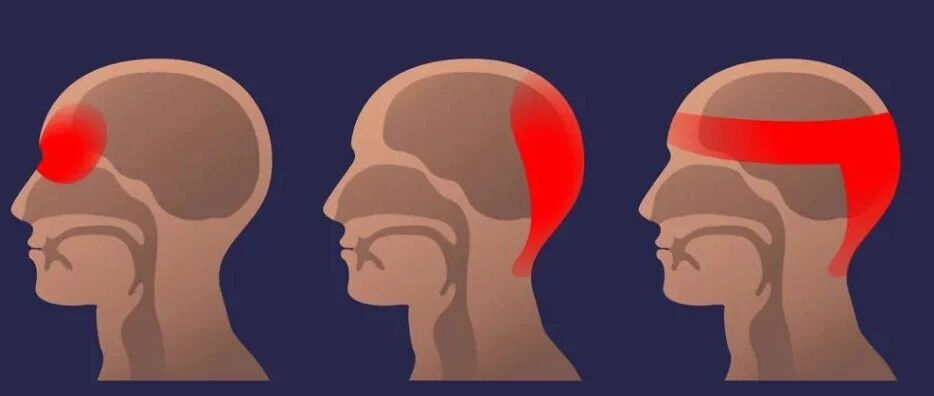 八成头痛和颈椎有关！一份“疼痛位置图解”帮你对症放松