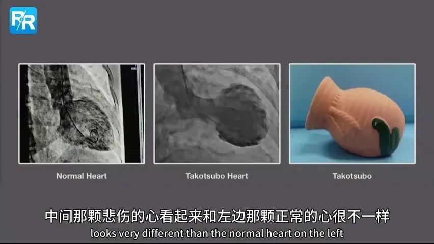 壞情緒讓心臟「變形」！你傷心時，心臟可能真在受傷 健康 第5張