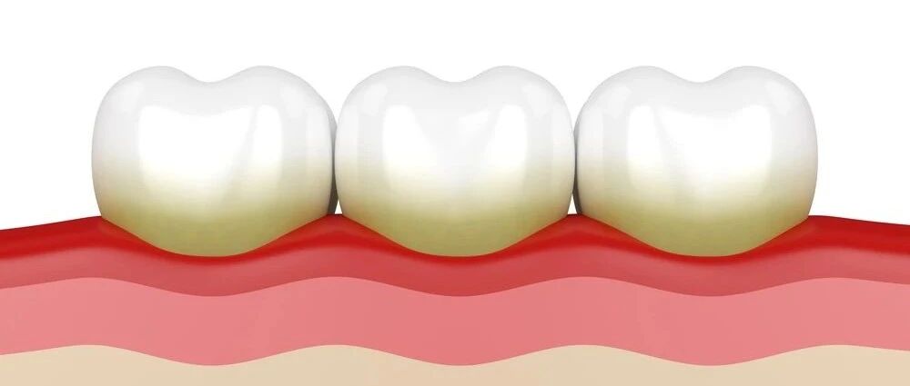 「牙结石」是怎么毁了一口好牙的？口腔科医生教你4个护牙法