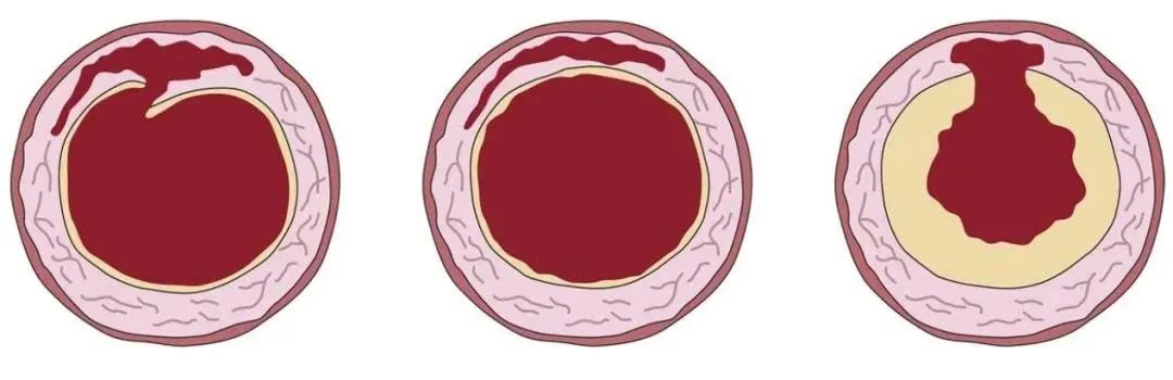 36歲男星因「主動脈夾層」離世！每年10月是它的發病高峰期 健康 第4張