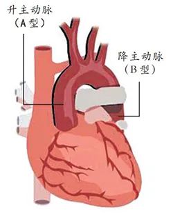 36歲男星因「主動脈夾層」離世！每年10月是它的發病高峰期 健康 第6張