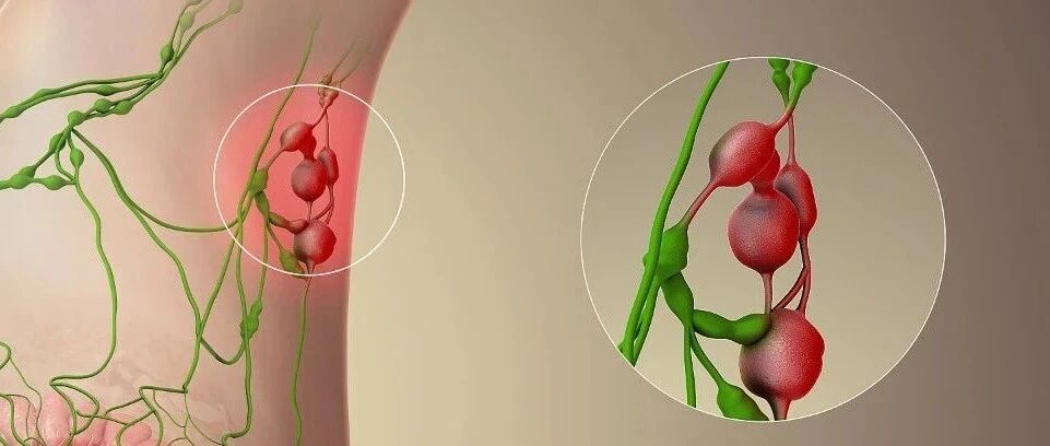 淋巴瘤喜欢“乔装改扮”，这2个年龄段是发病高峰