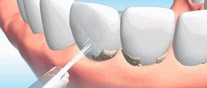 什么样的人最需要洗牙？这5类人被口腔科医生点名了