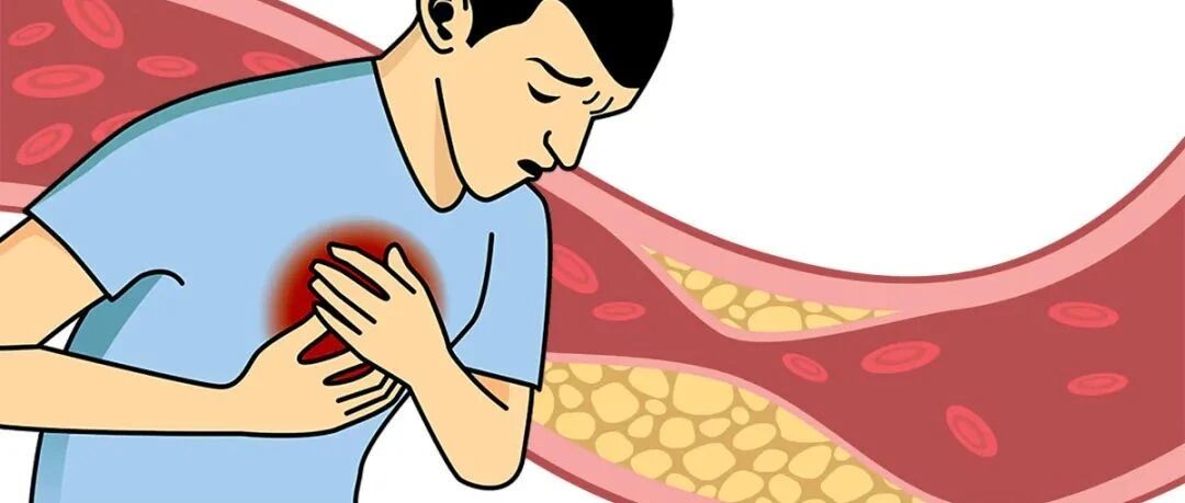 一个公式预测“冠心病”风险，来自权威心脏病专家的推荐