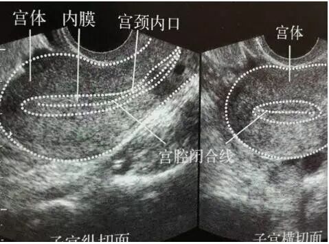 正常子宫形态超声解读
