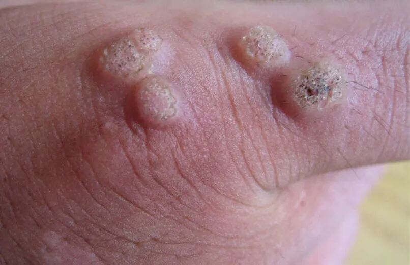 不痛不痒,可憎可恶的"瘊子"---疣_疣_介绍_症状表现 - 好大夫在线