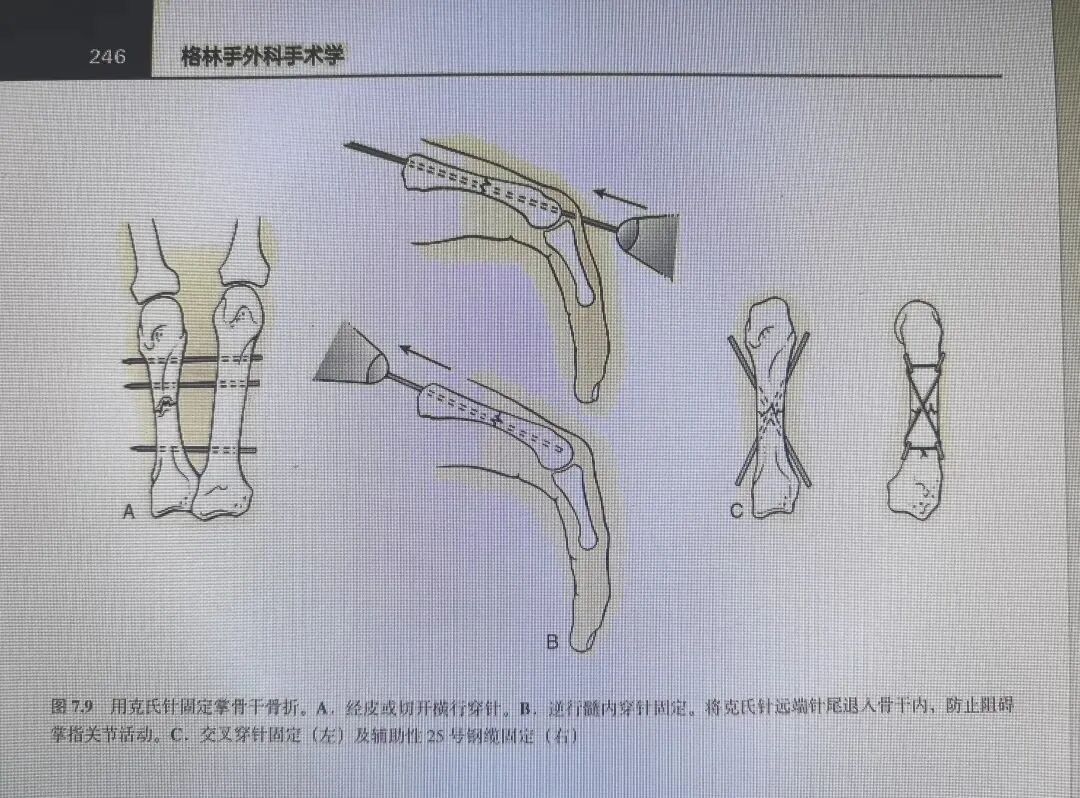 万能克氏针支架“隔山打牛”——掌骨骨折最实用的技术