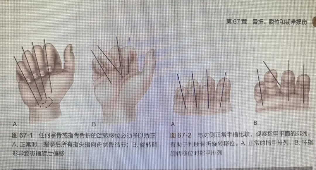 万能克氏针支架“隔山打牛”——掌骨骨折最实用的技术
