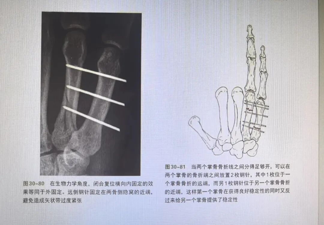 万能克氏针支架“隔山打牛”——掌骨骨折最实用的技术