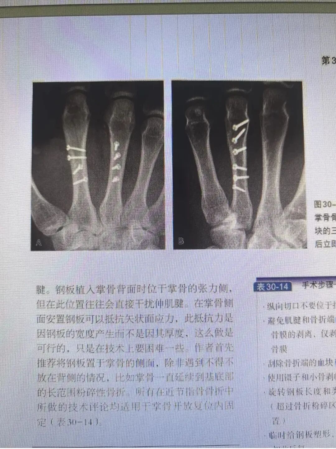 万能克氏针支架“隔山打牛”——掌骨骨折最实用的技术