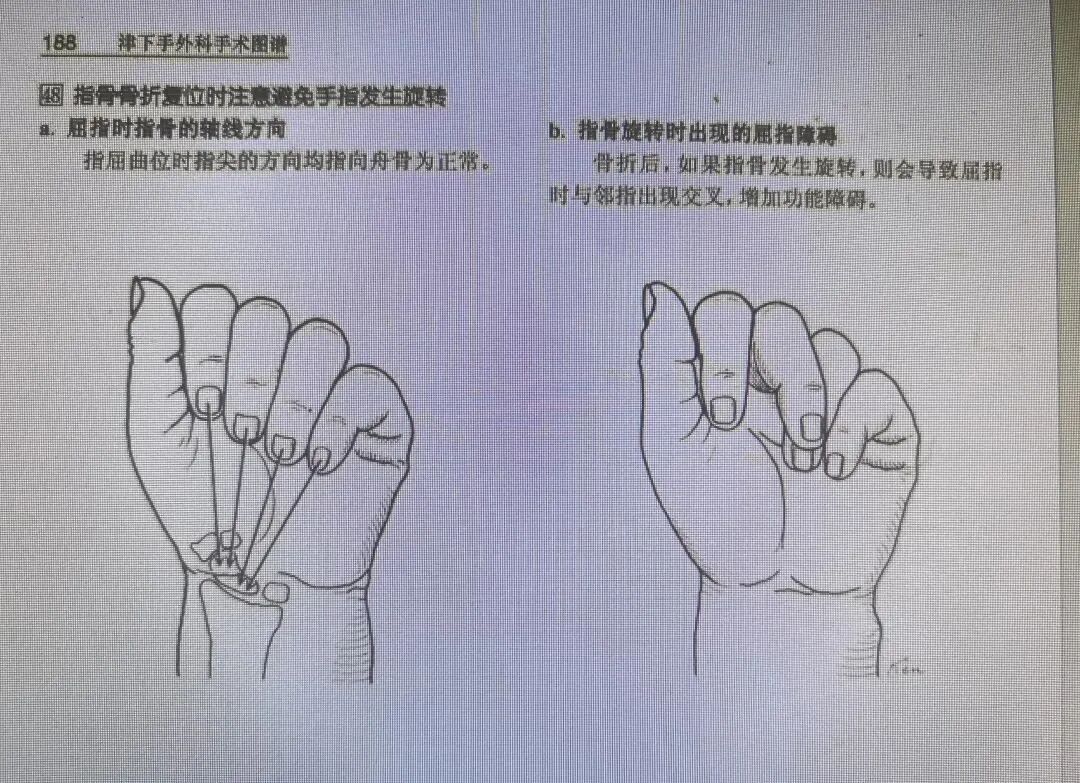 万能克氏针支架“隔山打牛”——掌骨骨折最实用的技术