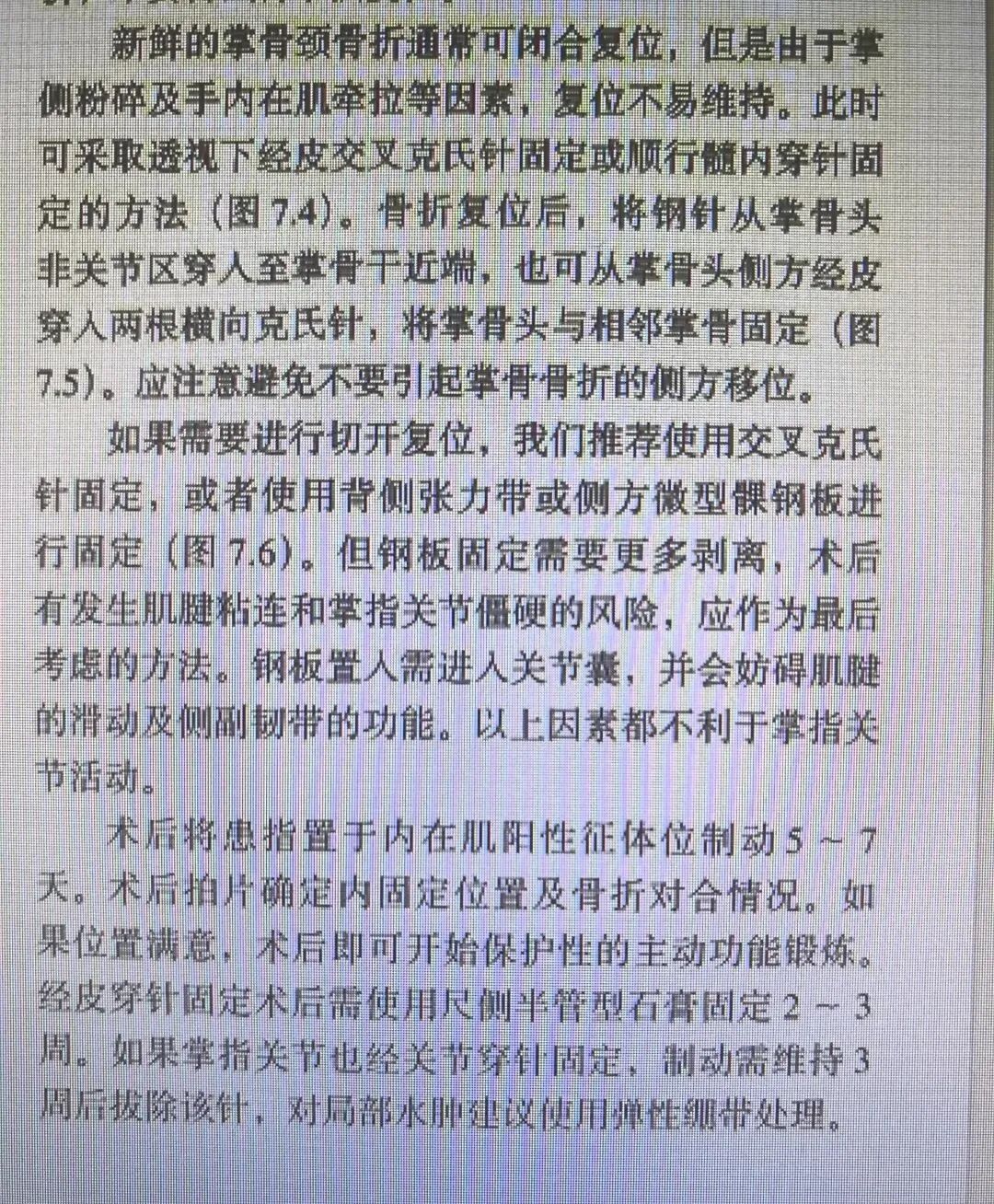 万能克氏针支架“隔山打牛”——掌骨骨折最实用的技术