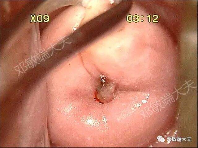 怎么样使用宫颈活检钳阴道镜检查不充分怎么办（2）？_https://www.jmylbn.com_新闻资讯_第3张