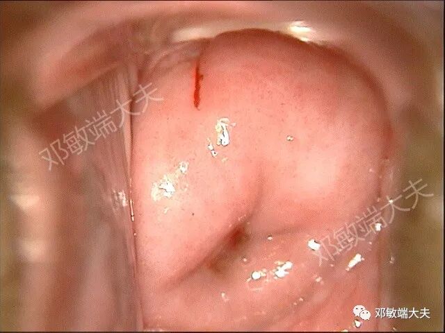 怎么样使用宫颈活检钳阴道镜检查不充分怎么办（2）？_https://www.jmylbn.com_新闻资讯_第2张