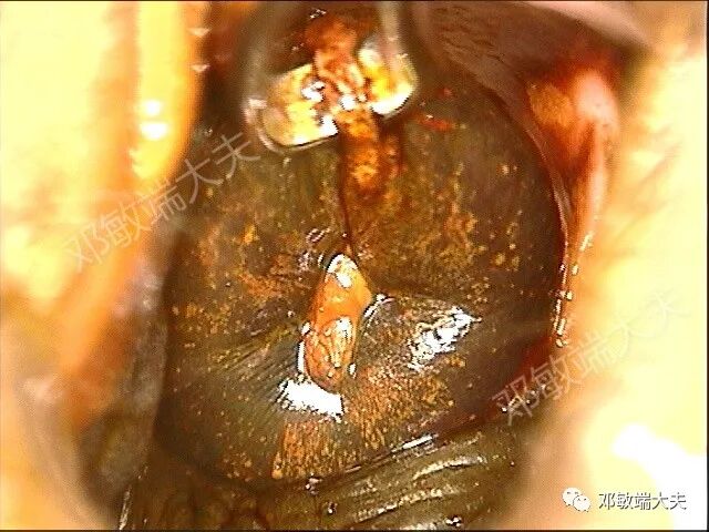 怎么样使用宫颈活检钳阴道镜检查不充分怎么办（2）？_https://www.jmylbn.com_新闻资讯_第4张