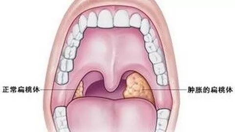 宝宝扁桃体反复发炎,如何预防?