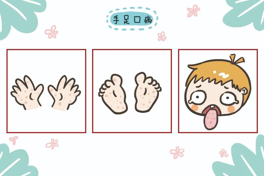 又到手足口高发期，家里有宝宝一定要小心！做好预防少受罪！
