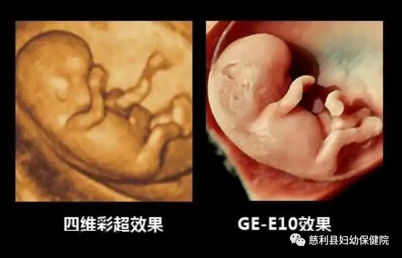 ge彩超怎么样“美国GE-E10”四维彩超界的战斗机—孕妈妈的首选！_https://www.jmylbn.com_新闻资讯_第10张
