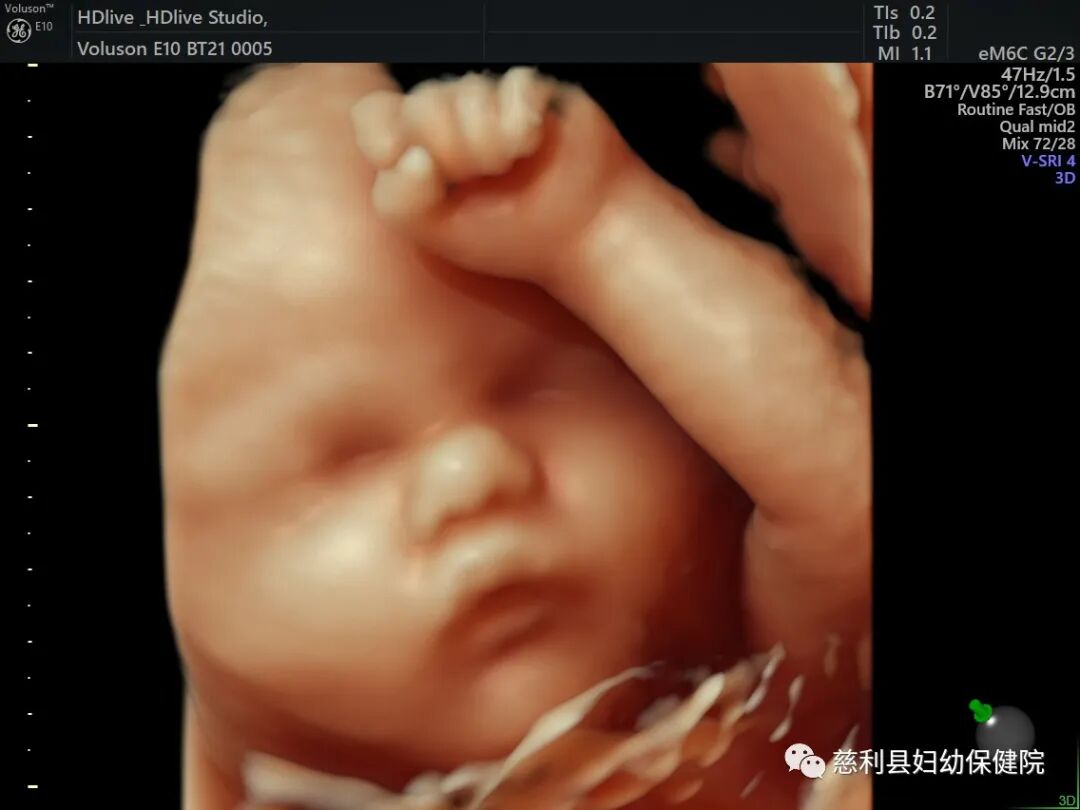 ge彩超怎么样“美国GE-E10”四维彩超界的战斗机—孕妈妈的首选！_https://www.jmylbn.com_新闻资讯_第9张