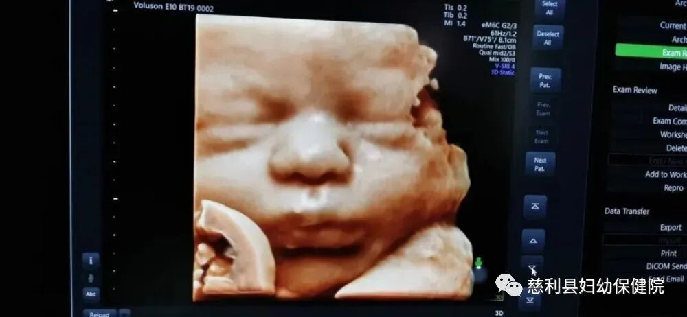 ge彩超怎么样“美国GE-E10”四维彩超界的战斗机—孕妈妈的首选！_https://www.jmylbn.com_新闻资讯_第8张