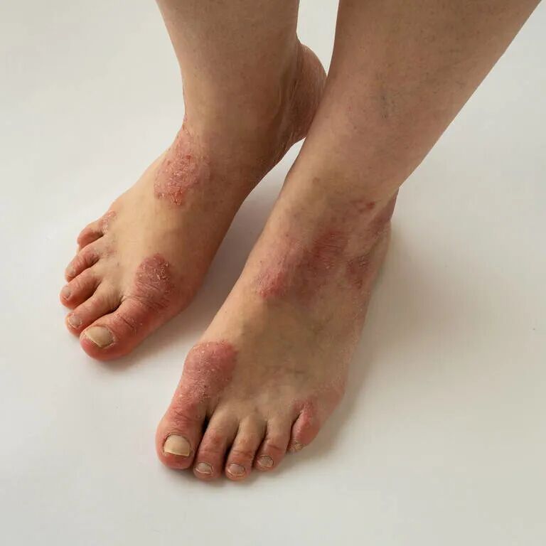 脚气会传染吗?快转发给家里人!