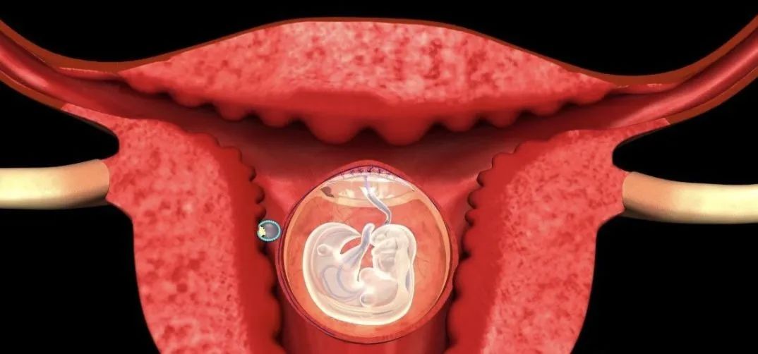 孕周,同时没有胎心管搏动,胎囊大小符合孕周或萎陷变形,称为孕囊枯萎
