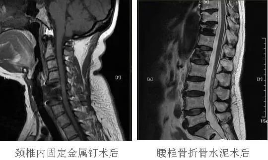 體內有植入物可以做磁共振檢查嗎