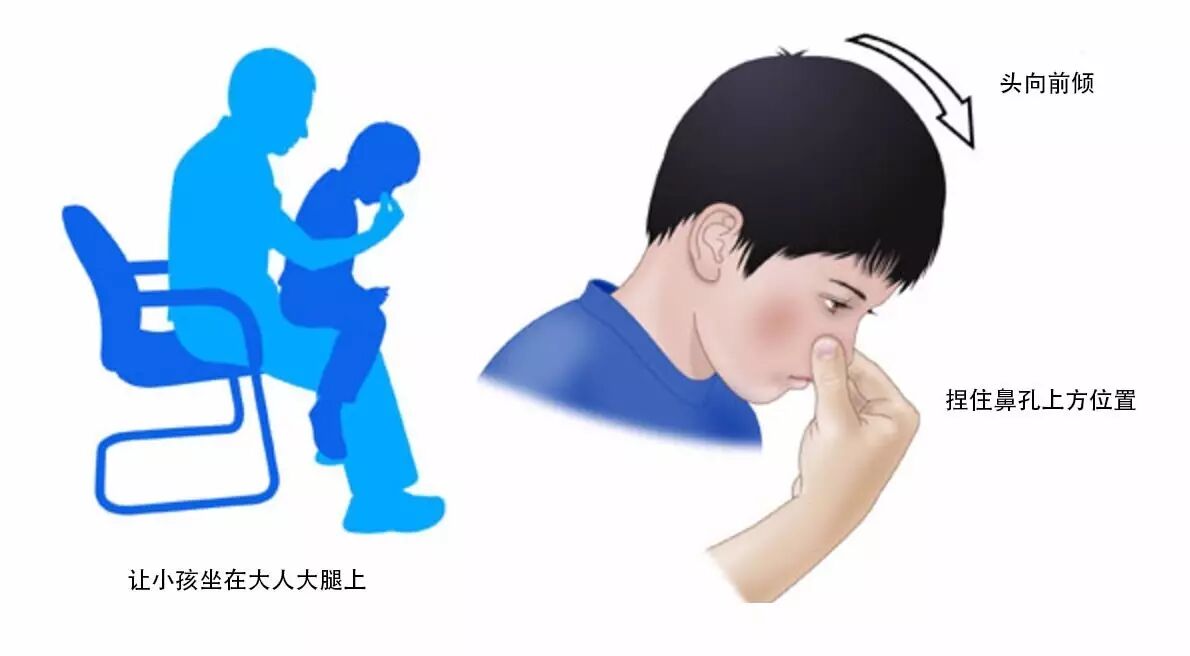 寶寶流鼻血了 該仰頭還是低頭 科學健康資訊 微文庫