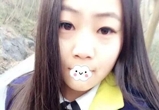 武汉天佑割双眼皮效果怎么样 看我真人案例整形恢复情况便知 蜜颜整形优惠