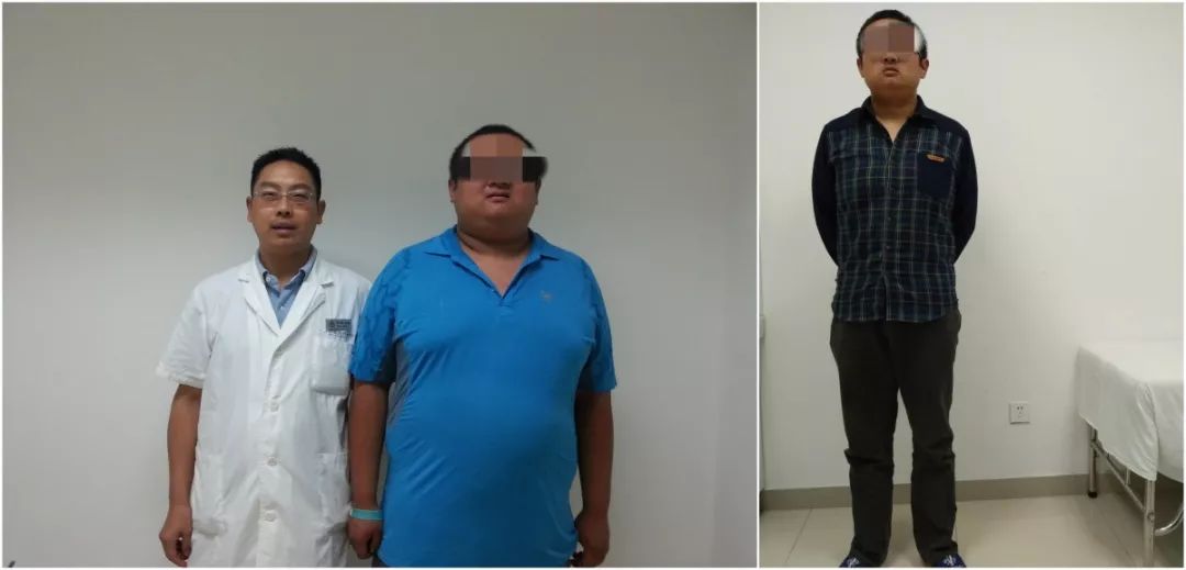 減肥手術哪種效果好_手術減肥_減肥手術是怎么做的