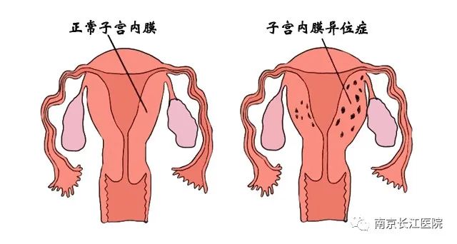内膜薄解决办法大盘点，总有一款适合你！