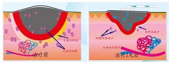 伤口负压治疗怎么收费慢创伤口患者的福音｜ 县民族中医院负压治疗技术运用成熟_https://www.jmylbn.com_新闻资讯_第14张