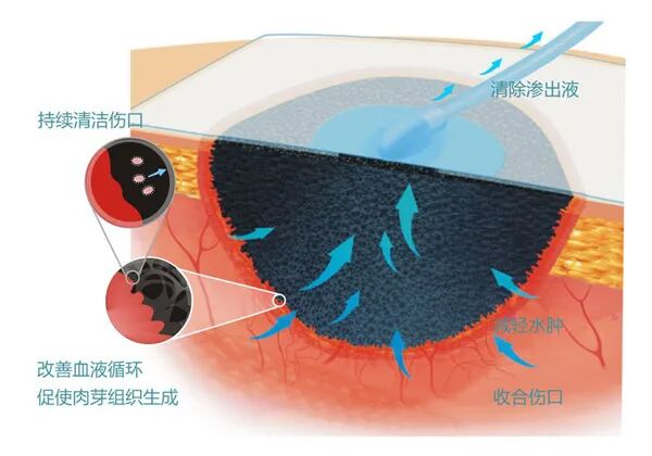 伤口负压治疗怎么收费慢创伤口患者的福音｜ 县民族中医院负压治疗技术运用成熟_https://www.jmylbn.com_新闻资讯_第13张
