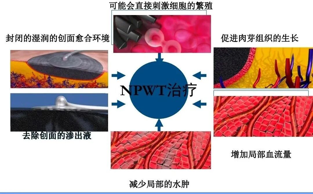 伤口负压治疗怎么收费慢创伤口患者的福音｜ 县民族中医院负压治疗技术运用成熟_https://www.jmylbn.com_新闻资讯_第15张