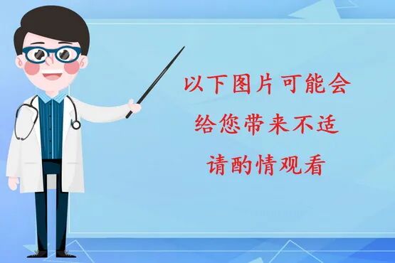 伤口负压治疗怎么收费慢创伤口患者的福音｜ 县民族中医院负压治疗技术运用成熟_https://www.jmylbn.com_新闻资讯_第2张