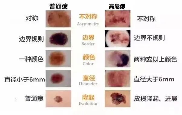 医用皮肤镜什么牌子好【科普】不是所有的“黑痣”都善良，皮肤镜帮您辨真伪_https://www.jmylbn.com_新闻资讯_第11张
