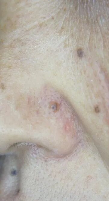 医用皮肤镜什么牌子好【科普】不是所有的“黑痣”都善良，皮肤镜帮您辨真伪_https://www.jmylbn.com_新闻资讯_第4张